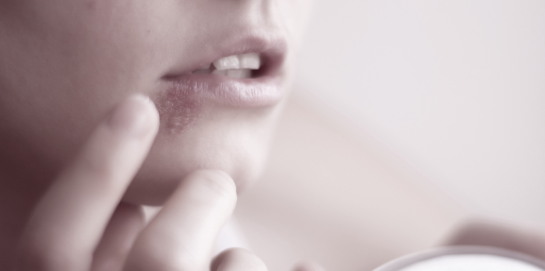 A herpesz és a lézeres szőrtelenítés